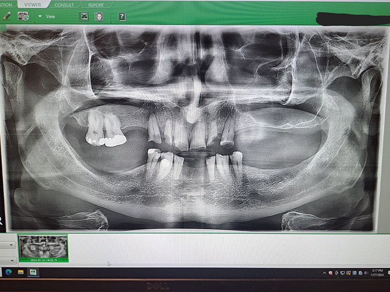 Akron Area Oral Maxillofacial Facial Cosmetic Surgery Center | Corrective Jaw Surgery, Wisdom Teeth and Facial Injuries Reconstruction