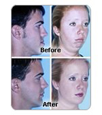 Reconstructive Jaw Surgery near Akron